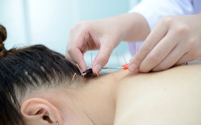 Hvad er elektronisk akupunktur?