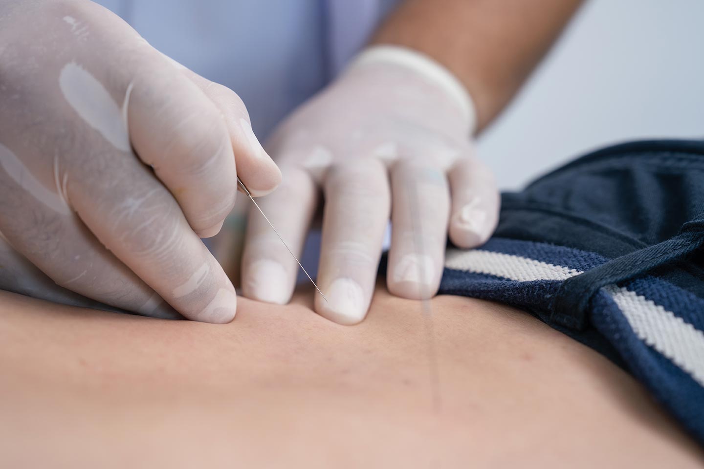 akupunkturbehandling i lemvig hos Nasii Akupunktur